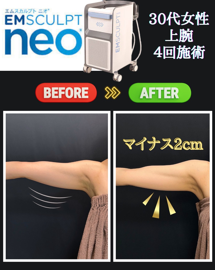 医療瘦身機「エムスカルプトneo」について✨